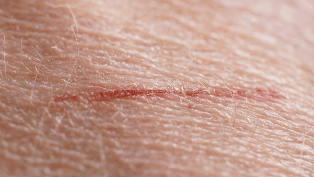 Corte leve en la piel